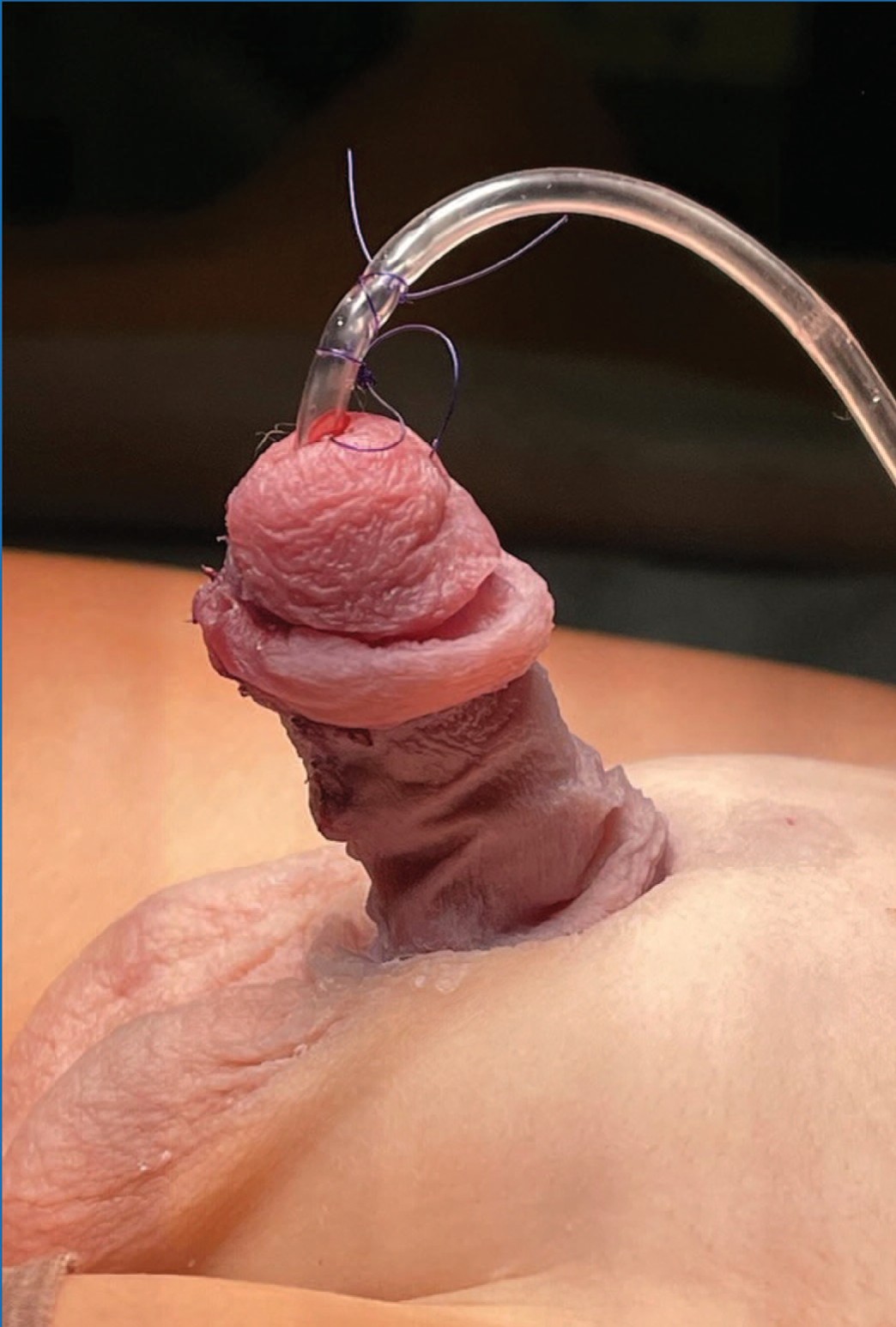 Вид полового члена при использовании акрилатного апплицирования после операции по поводу гипоспадии