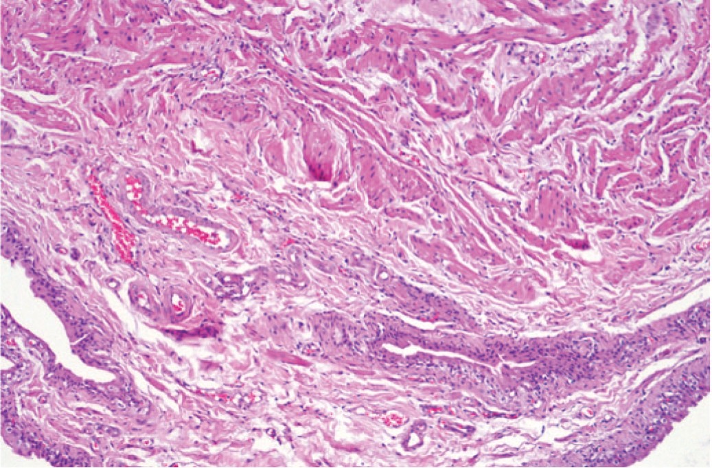 Гипертрофия мочевого пузыря и гиперплазия уротелия у крыс с МС. Окраска гематоксилином и эозином. Ув. 100х