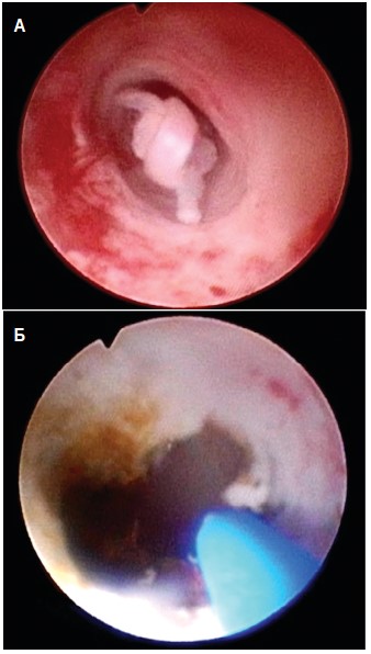 Пациент Б., 58 лет. Уретероскопическая картина опухоли левого мочеточника до эндоскопического удаления с применением лазерной энергии (А) и после него (Б)