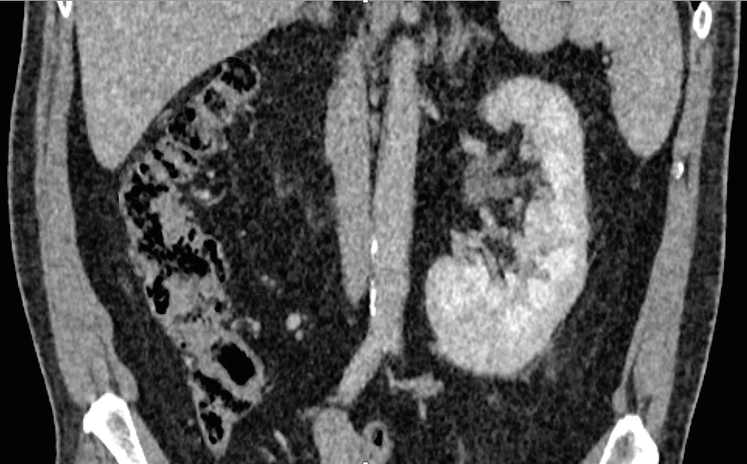 Мультиспиральная компьютерная томография органов брюшной полости и забрюшинного пространства