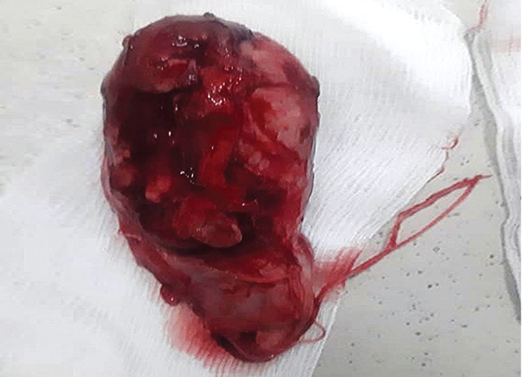 Операционный препарат, уделенное левое яичко с некротическими изменениями и кровоизлияниями всех тканей