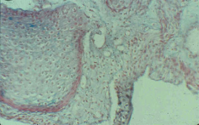 Плоскоклеточная метаплазия ацинарного эпителия. Окраска по Крейбергу. Х 100