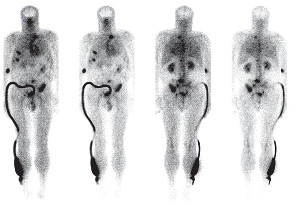 Визуализация очагов поражения скелета с Резосканом, 99mTc у больного РПЖ на фоне лечения препаратом золедроновой кислоты в течение 2 месяцев