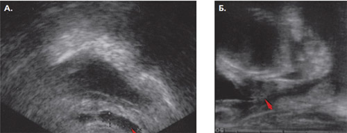 Трансректальное ультразвуковое исследование до сеанса HIFU. Резидуальные семенные пузырьки: поперечное (А) и продольное (Б) изображение.