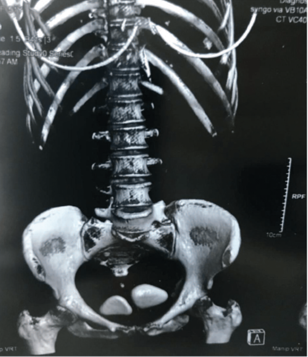 Компьютерная томография брюшной полости и органов малого таза. Камни мочевого пузыря