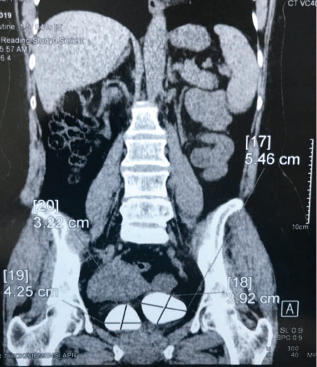 Компьютерная томография брюшной полости и органов малого таза. Камни мочевого пузыря