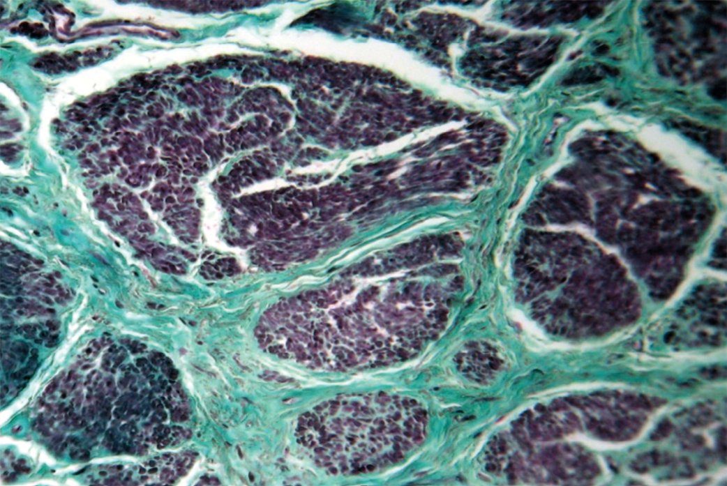 Рис. 2. Разрастание грубоволокнистой соединительной ткани в виде узкопетлистой сети между атрофированными мышечными пучками. Окраска по Массону. Увеличение 160 