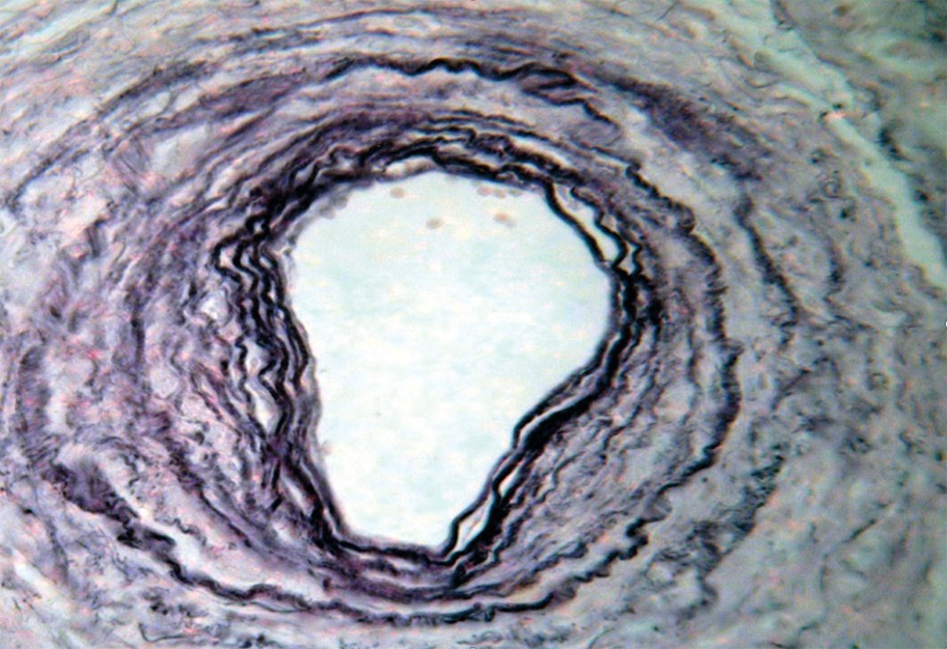 Рис. 3. Крупная артерия мышечного типа с утолщенными стенками и расщеплением внутренней эластической мембраны на отдельные пластинки. Окраска по Харту. Увеличение 200 