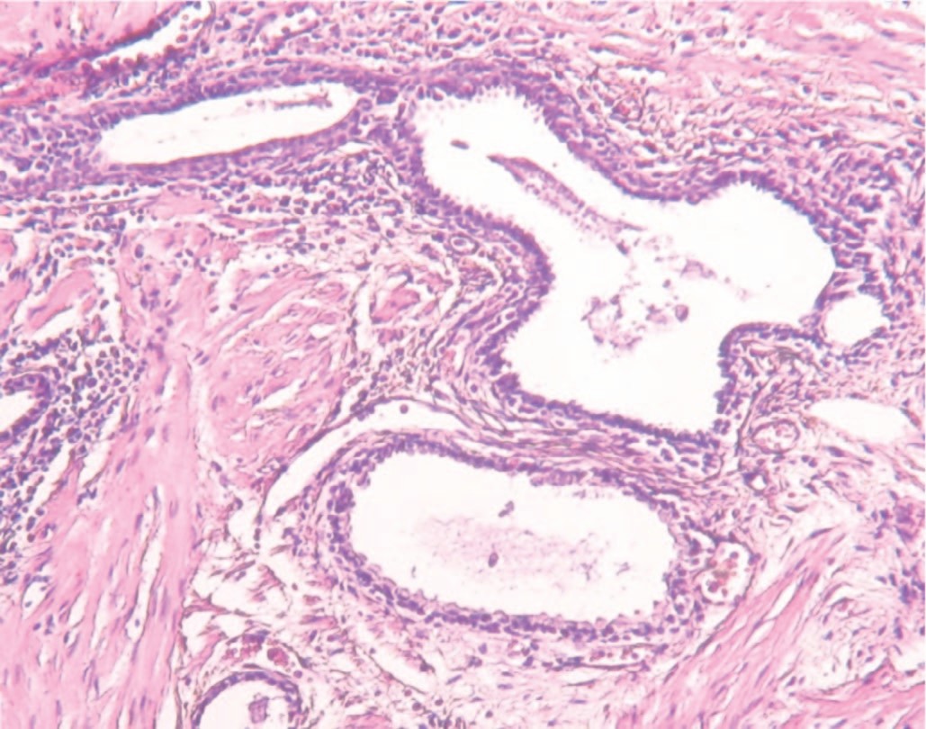 Склеротические процессы в ткани ПЖ с выраженным нарушением анатомического строения долек органа на фоне хронического воспаления. Окр. гематоксилином и эозином. Увеличение 100