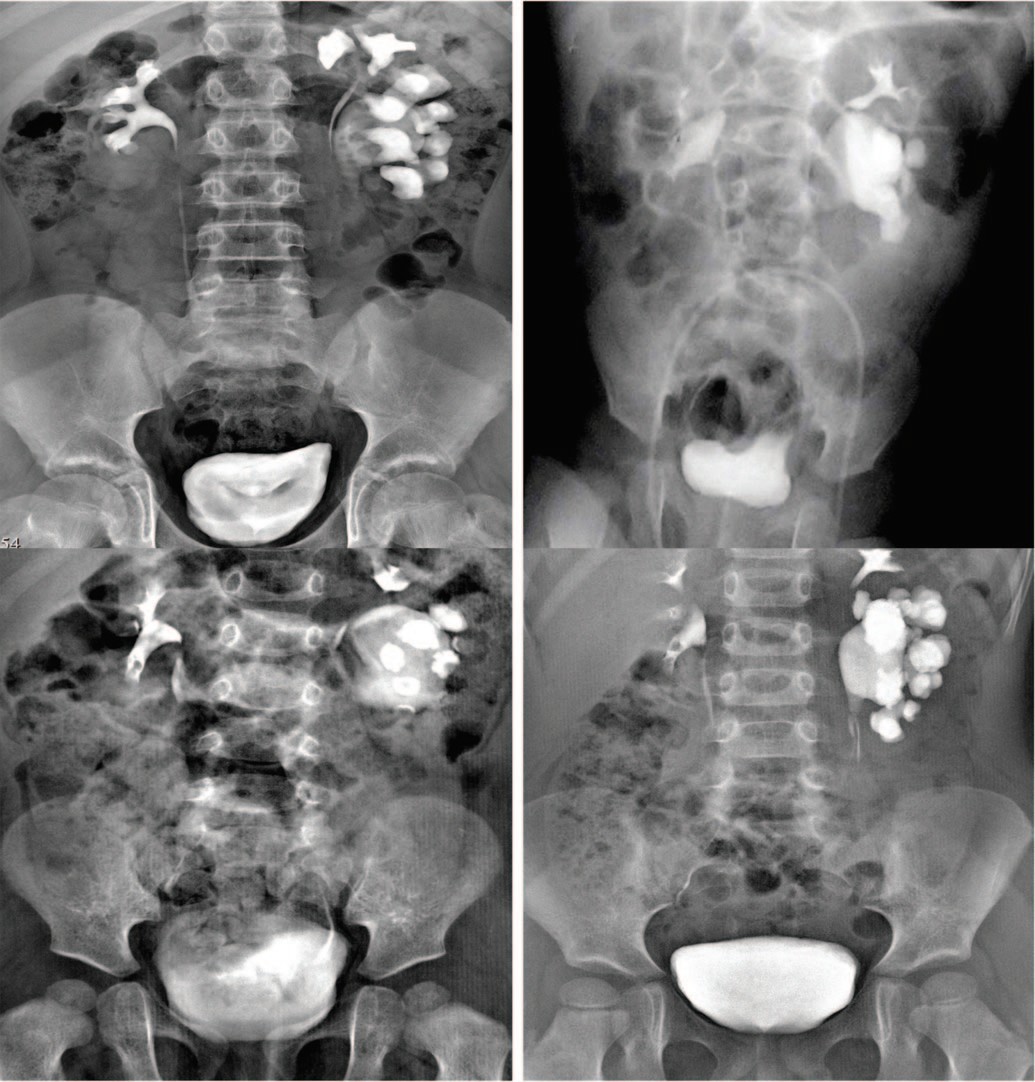 Экскреторные урограммы пациентов с гидронефрозом нижней половины на фоне неполного УВМП 