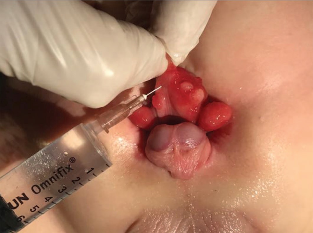 Обкалывание стенки мочевого пузыря с полипозными разрастаниями Ботулиническим анатоксином типа А у ребенка 7 мес с экстрофией и микроцистисом.