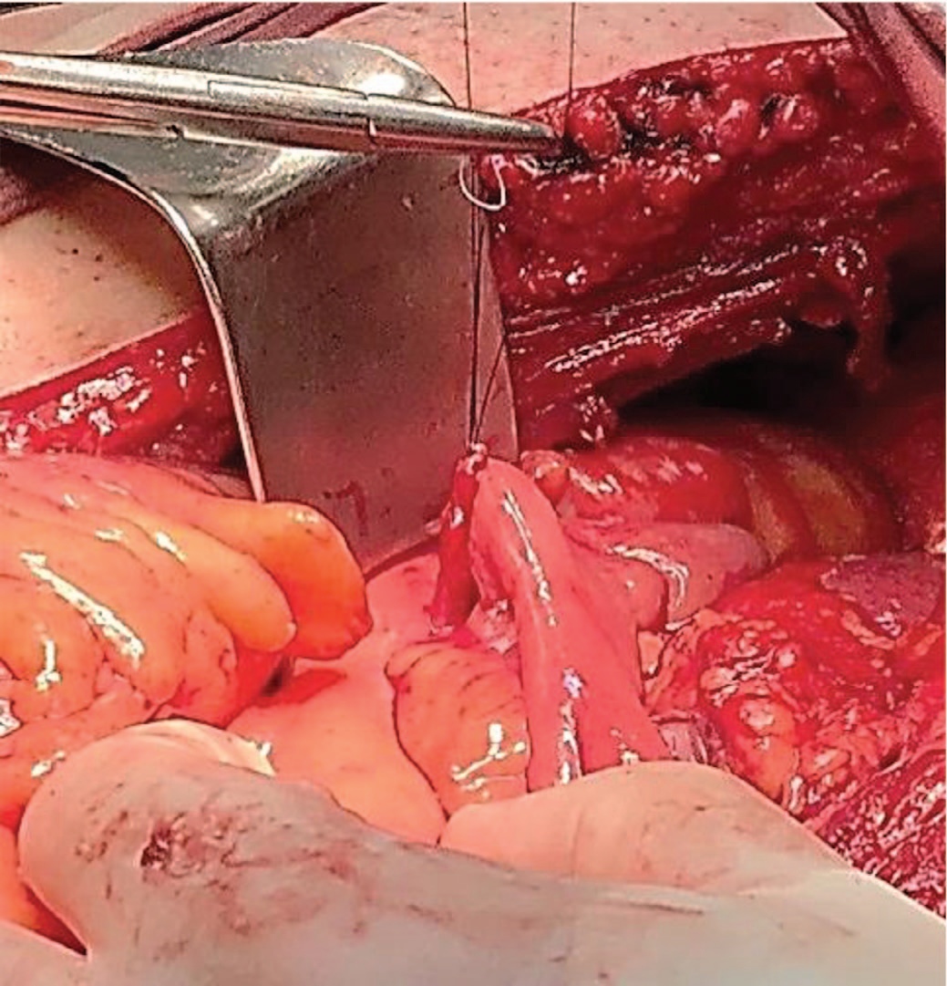 Анастомоз левого мочеточника и кондуита конец-в-бок