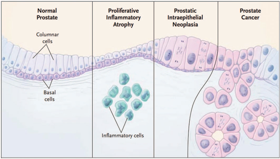 Пролиферативная воспалительная атрофия как предшественник простатической интраэпителиальной неоплазии и рака предстательной железы. Слева направо: 1-ая картинка - Нормальный эпителий (название), столбчатые клетки (вверху), базальные клетки (внизу); 2-ая картинка – пролиферативная воспалительная атрофия (название), воспалительные клетки (внизу); 3-я картинка – ПИН; 4-ая картинка – РПЖ [24]