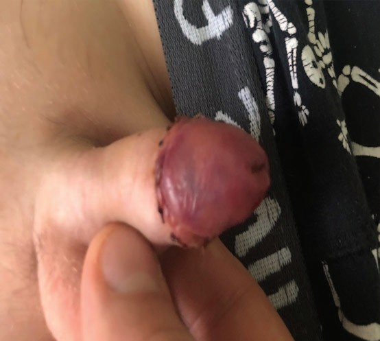 Половой член на пятые послеоперационные сутки, гемодинамические нарушения устранены