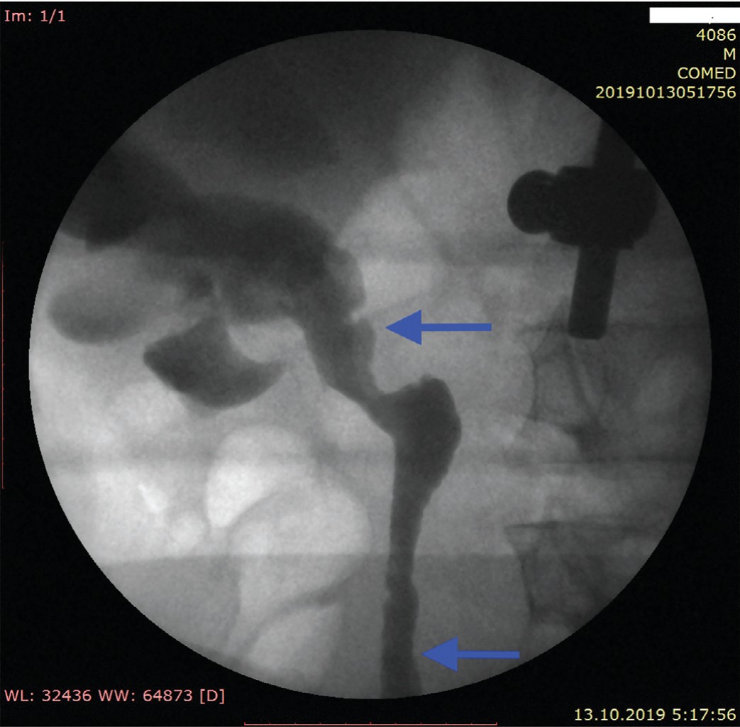 Замещенный участок мочеточника – показан стрелками (ретроградная уретеропиелография через 12 недель после операции) 