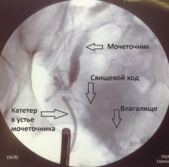 Treatment for urethrovaginal fistilas
