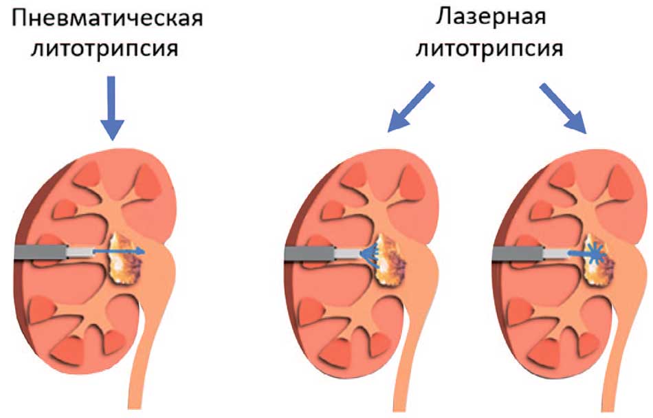 Приемы пневматической и лазерной литотрипсии