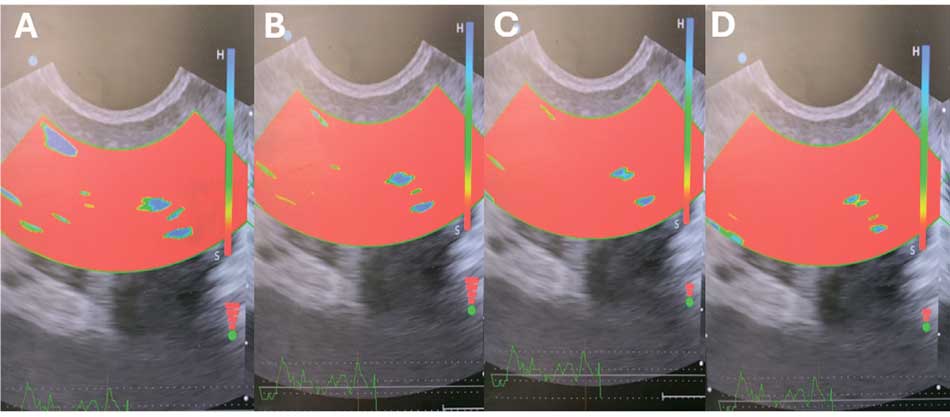 Динамика картины соноэластографии предстательной железы в группе 3 до и после лечения: А – 0 неделя; В – 18 неделя; С – 30 неделя; D – 54 неделя