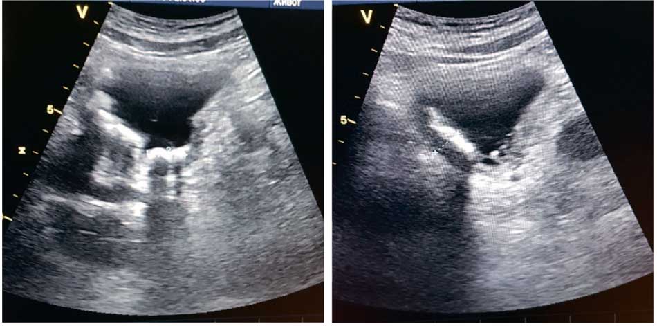 Ультразвуковая картина — гиперэхогенные образования в просвете мочевого пузыря