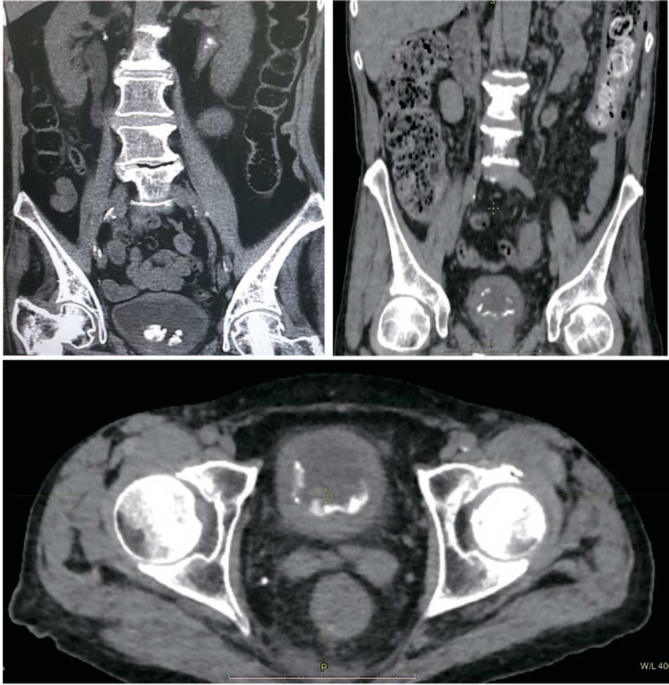 Компьютерная томография. Картина конкрементов в просвете мочевого пузыря при инкрустирующем цистите
