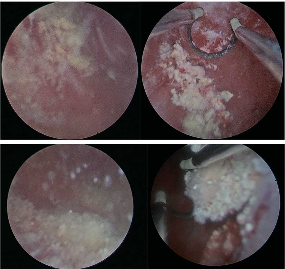 Цистоскопическая картина инкрустирующего цистита