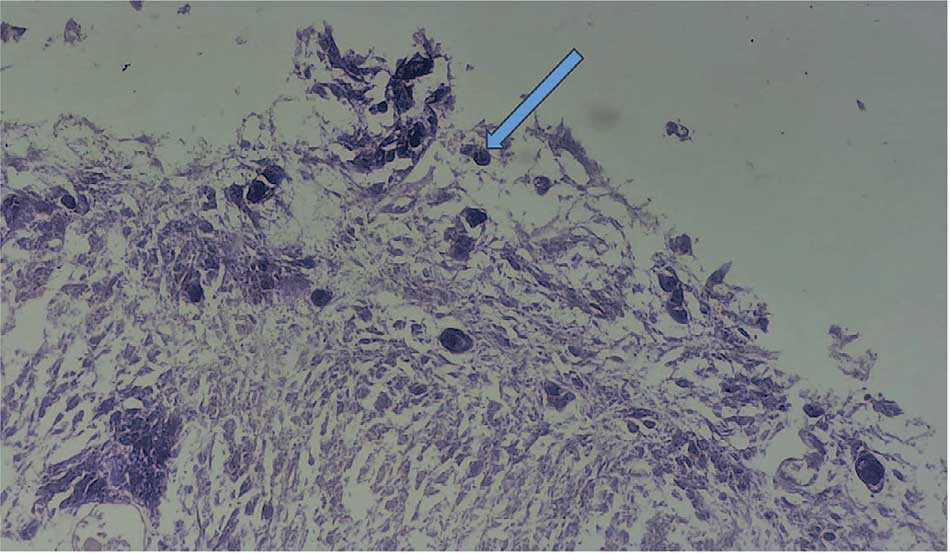 Гистологическая картина при инкрустирующем цистите картина продуктивного воспаления с выраженным ангиоматозом, слабой лимфои плазмоцитарной инфильтрацией по типу незрелой грануляционной ткани; реактивная гиперплазия переходного эпителий с хорошо выраженной интраэпителиальной лейкоцитарной инфильтрацией