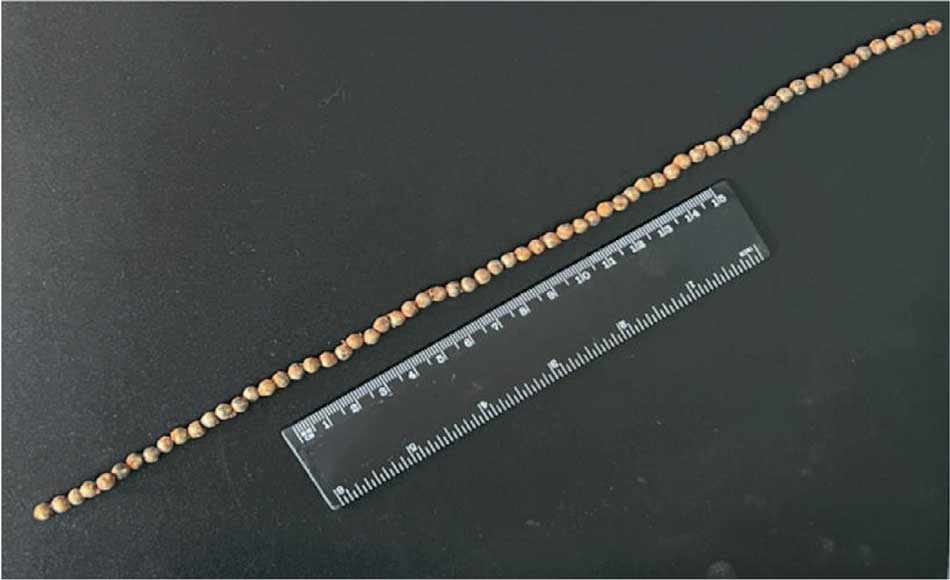 65 магнитных шарика после удаления из мочевого пузыря