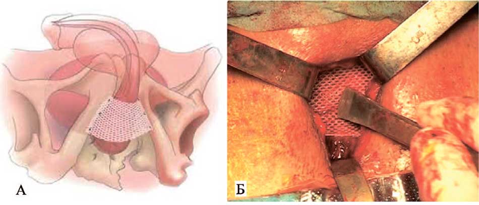 Слинг InVance®: А схематическое изображение расположения и точек фиксации слинга; Б – внешний вид слинга во время имплантации