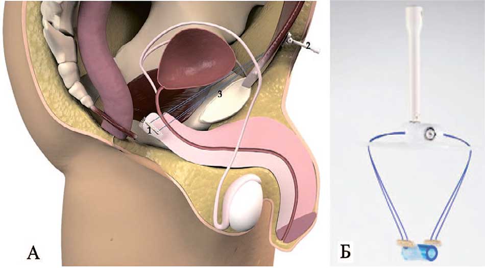 Слинг Remeex® male