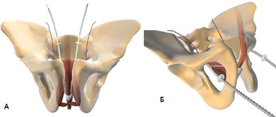 А – слинг Argus® (позадилонный доступ)