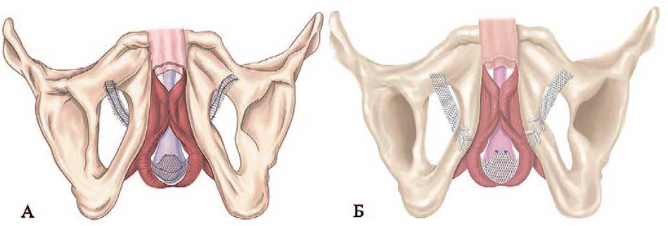 А — слинг AdVance®, Б — слинг AdVance® XP