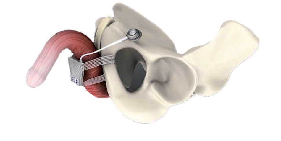 Слинг A.M.I.® ATOMS