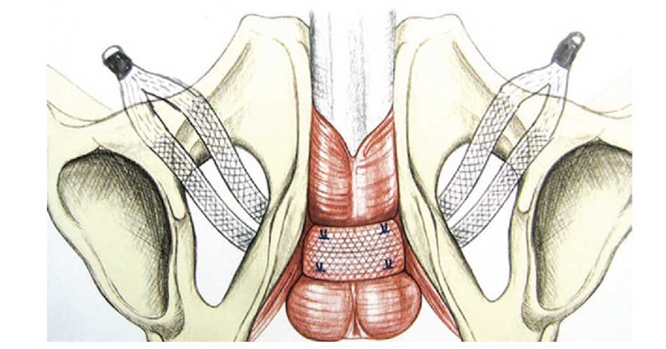 Слинг I-STOP TOMS® 