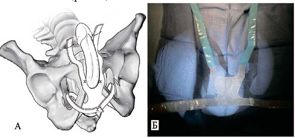 Слинг Virtue® quadratic