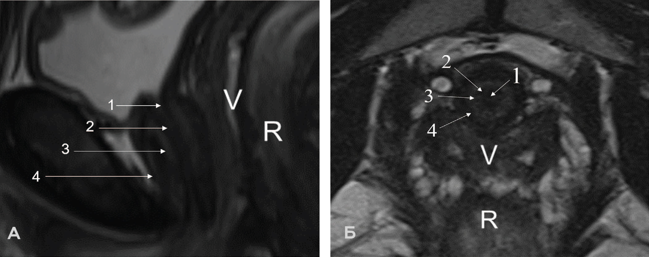 Зональная анатомия нормальной женской уретры на МРТ