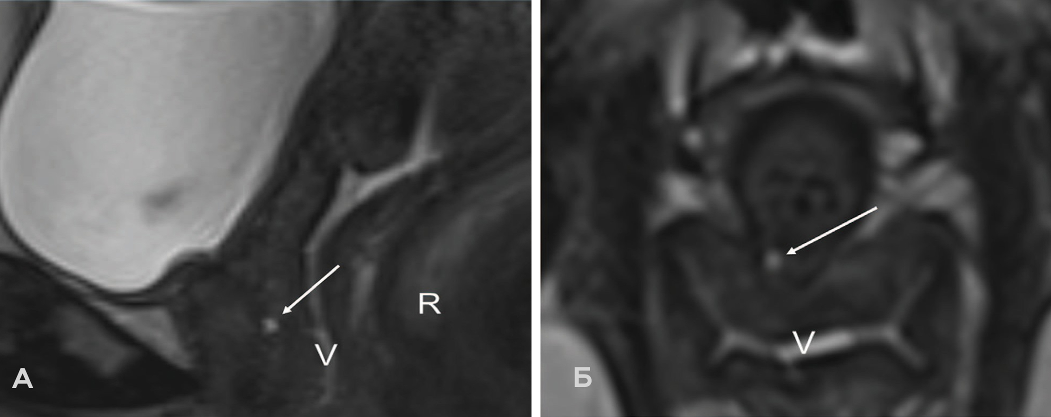 МР-картина мелкокистозной структуры в подслизистом слое задней стенки уретры