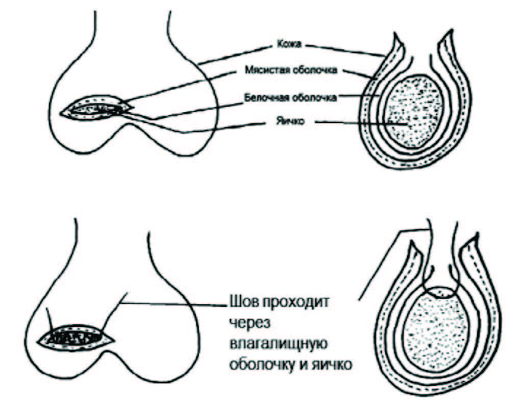 Фиксация яичка по L. Duglas при внутриоболочечном перекруте