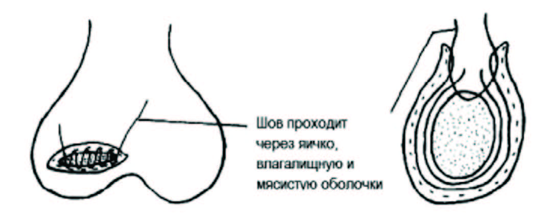 Фиксация яичка по L. Duglas при внеоболочечном перекруте