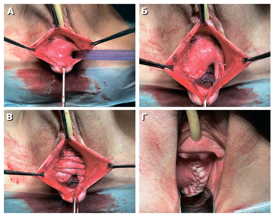Этапы гибридной реконструкции тазового дна с применением частично резорбируемой системы доставки лигатур для аксиальной фиксации структур тазового дна