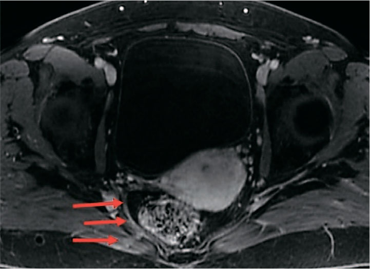 Пациентка Б. 56 лет. МРТ органов малого таза