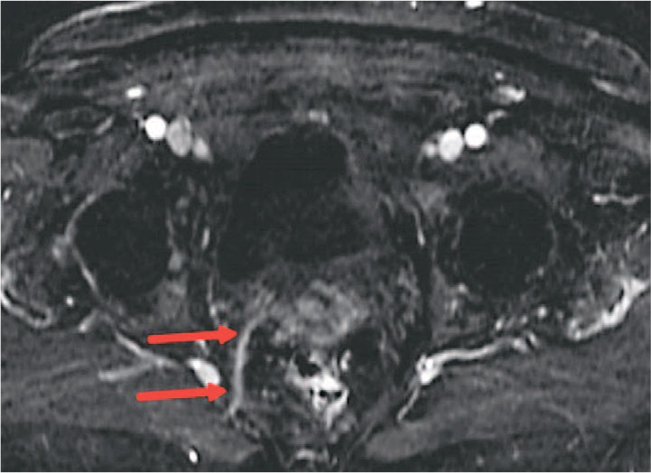 Пациентка Г. 72 года. МРТ органов малого таза