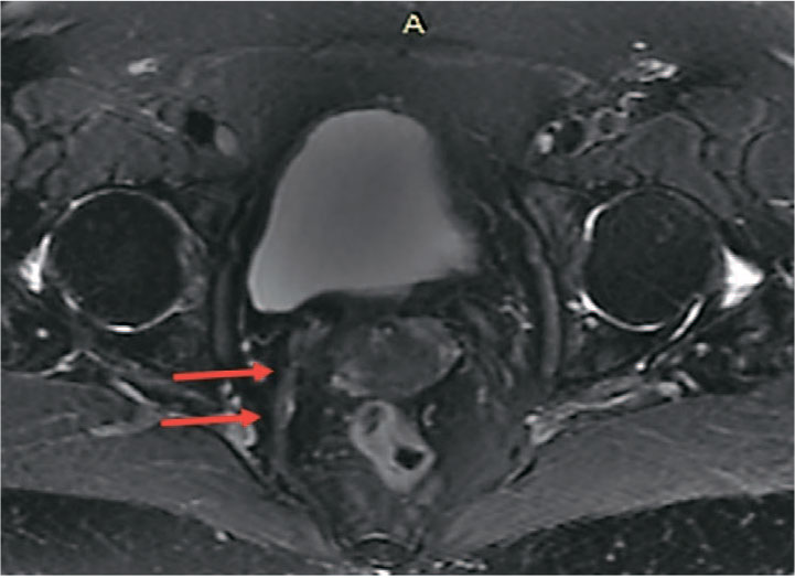 Пациентка Г. 72 года. МРТ органов малого таза