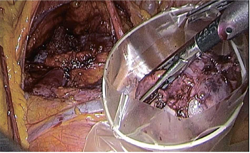 Опухоль удалена через окно в брыжейке толстой кишки и помещена в контейнер