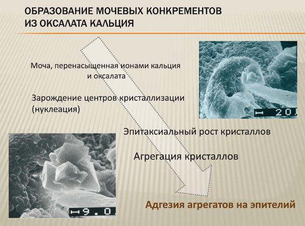 Образование мочевых конкрементов из оксалата кальция