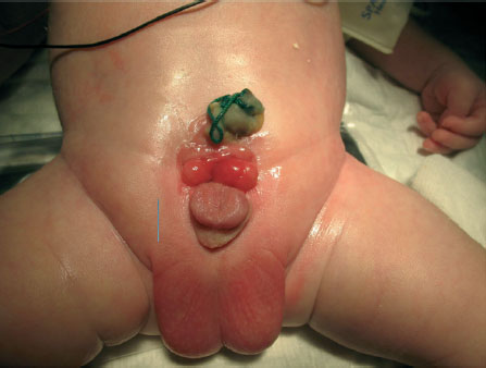 Ребенок Ю. 2 дней жизни до операции. Размер пузырной площадки 2,3см