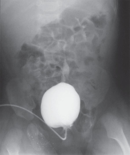 Цистограмма больного Д. через 1,5 года после операции. Имеется ПМР 2-3 степени слева. Объем мочевого пузыря 70,0мл. Мочится порциями. Сухой промежуток 30 минут