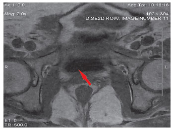 МРТ органов малого таза до HIFU (резидуальные семенные пузырьки, очаг рецидива).
