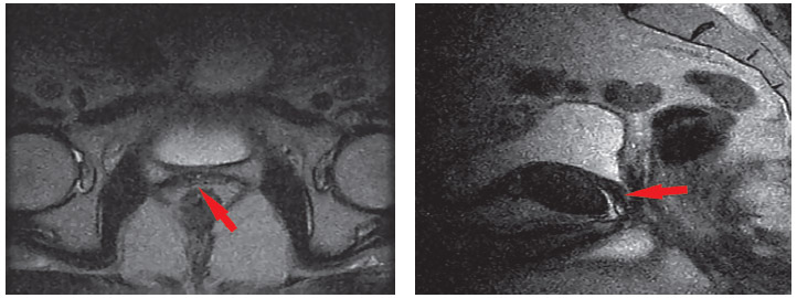 МРТ органов малого таза (резидуальные семенные пузырьки, очаг рецидива). 