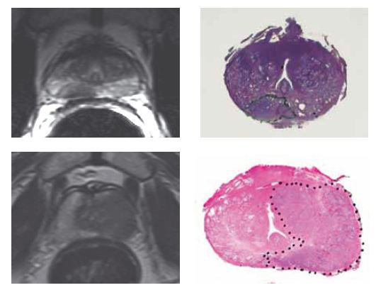 Рак предстательной железы: при МРТ и гистологическом исследовании