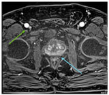 МРТ изображение Т1 с подавлением жира при контрастировании